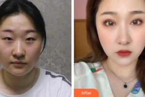 吉林市中心醫(yī)院燒傷整形外科樸俊宇整形價(jià)格表附眼部綜合案例展示