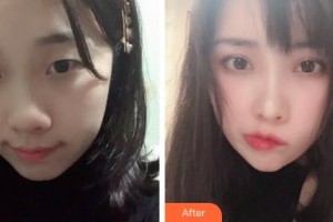 吉林大學(xué)中日聯(lián)誼醫(yī)院燒傷整形外科林駐煥整形價(jià)格表附眼部綜合案例展示