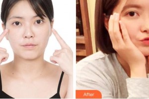 吉林市中心醫(yī)院燒傷整形外科王大壯整形價(jià)格表附開(kāi)內(nèi)眼角案例展示