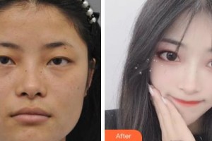 吉林省人民醫(yī)院燒傷整形科劉進(jìn)輝整形價(jià)格表附眼部綜合案例展示