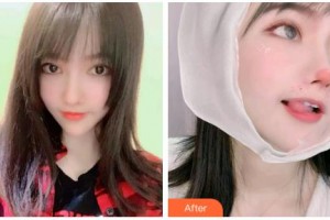 吉林市中心醫(yī)院燒傷整形外科趙鐵成整形價(jià)格表附切開(kāi)雙眼皮案例展示