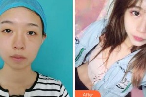 吉林市中心醫(yī)院燒傷整形外科施占軍整形價(jià)格表附眼部綜合案例展示