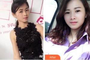 吉林大學(xué)中日聯(lián)誼醫(yī)院燒傷整形外科王之清整形價(jià)格表附切開(kāi)雙眼皮案例展示