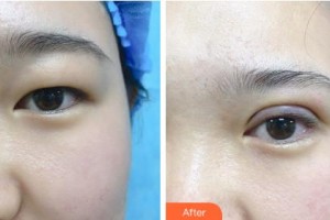 吉林市中心醫(yī)院燒傷整形外科林貞姬整形價(jià)格表附眼部綜合案例展示