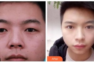 吉林瑞澳醫(yī)學(xué)美容醫(yī)院井明整形價(jià)格表附切開(kāi)雙眼皮案例展示