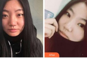 吉林市中心醫(yī)院燒傷整形外科張雪峰整形價(jià)格表附埋線雙眼皮案例展示