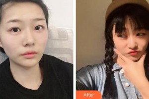 長(zhǎng)春劉金梅美容整形外科診所劉金梅整形價(jià)格表附激光去眼袋案例展示