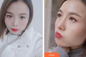 長(zhǎng)春正韓醫(yī)療美容醫(yī)院張志雪整形價(jià)格表附肋軟骨隆鼻案例展示