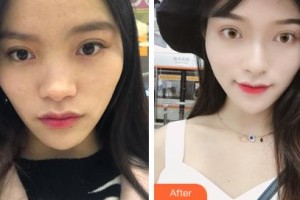 長(zhǎng)春中心醫(yī)院綜合燒傷科楊潤(rùn)華整形價(jià)格表附肋軟骨隆鼻案例展示