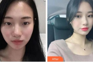 長(zhǎng)春正韓醫(yī)療美容醫(yī)院于俐媛整形價(jià)格表附切開(kāi)雙眼皮案例展示