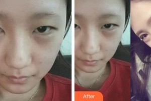 長(zhǎng)春珍妮醫(yī)療美容醫(yī)院鄭乃誠(chéng)整形價(jià)格表附眼部綜合案例展示