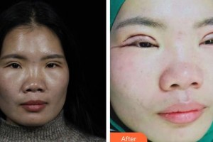 長(zhǎng)春正韓醫(yī)療美容醫(yī)院林偉卓整形價(jià)格表附切開(kāi)雙眼皮案例展示