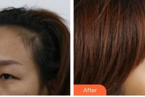 長(zhǎng)春愛(ài)麗醫(yī)療美容門(mén)診部金詠晙整形價(jià)格表附上眼瞼去脂案例展示