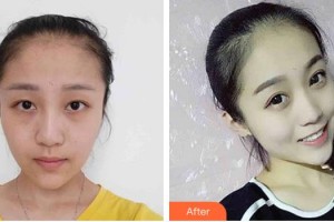 長(zhǎng)春西之米醫(yī)療美容醫(yī)院李志成整形價(jià)格表附外切祛眼袋案例展示