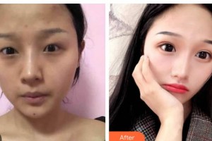 長(zhǎng)春圣華抗衰老醫(yī)學(xué)研究院張曼整形價(jià)格表附切開雙眼皮案例展示