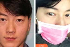 長(zhǎng)春宮麗娟醫(yī)療美容診所宮麗娟整形價(jià)格表附定點(diǎn)雙眼皮案例展示