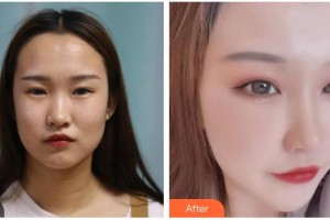 長(zhǎng)春圣華抗衰老醫(yī)學(xué)研究院池岳龍整形價(jià)格表附眼部綜合案例展示