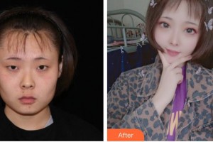 長(zhǎng)春華璦美容醫(yī)院龔春靜整形價(jià)格表附眼部綜合案例展示