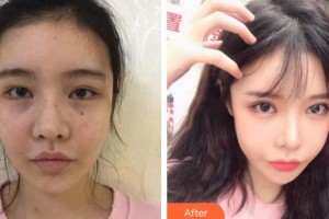 長(zhǎng)春韓合愛(ài)心美容醫(yī)院孫琦整形價(jià)格表附眼部綜合案例展示