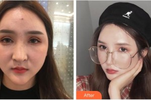 長(zhǎng)春奧拉克美容醫(yī)院陳繼革整形價(jià)格表附手術(shù)縮鼻頭案例展示