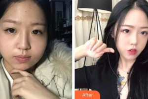 長(zhǎng)春奧拉克美容醫(yī)院安淅鏞整形價(jià)格表附光子嫩膚案例展示