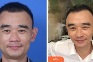 長春中妍醫(yī)療美容醫(yī)院竇穎整形價格表附激光祛斑案例展示