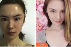 長春中妍醫(yī)療美容醫(yī)院李沖住院醫(yī)師整形價格表附玻尿酸精華導入案例展示