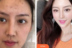 長春美奇醫(yī)療美容外科門診部劉林熹整形價格表附埋線提升案例展示