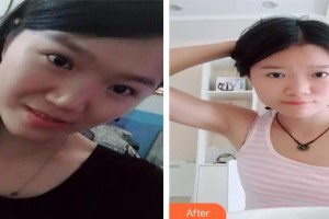 長(zhǎng)春美奇醫(yī)療美容外科門診部張鵬飛整形價(jià)格表附埋線提升案例展示