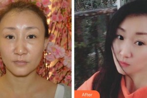 長春奧萊依醫(yī)療美容醫(yī)院胡海吉整形價格表附埋線提升案例展示