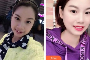 長春白求恩口腔醫(yī)院孫凱整形價格表附金屬托槽矯正案例展示