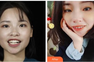 長春白求恩口腔醫(yī)院楊溢整形價格表附金屬托槽矯正案例展示