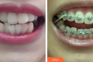 長春詩邁爾口腔門診部宋邦嘯整形價格表附金屬托槽矯正案例展示