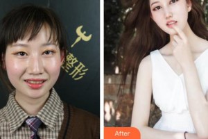 四平市燒傷整形醫(yī)院王國才整形價(jià)格表附牙齒隱形矯正案例展示