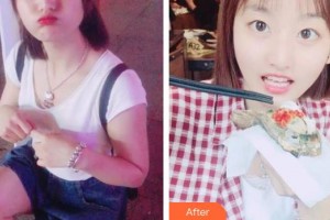 四平市燒傷整形醫(yī)院衛(wèi)長(zhǎng)榮整形價(jià)格表附美白劑美白牙齒案例展示