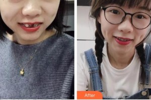 四平王清純醫(yī)療美容診所王清純整形價(jià)格表附金屬托槽矯正案例展示