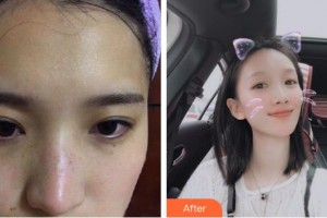 四平王清純醫(yī)療美容診所孫益民整形價(jià)格表附激光祛斑案例展示