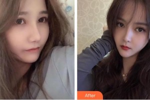 四平市中心醫(yī)院整形美容科馬群整形價(jià)格表附清潔祛痘案例展示