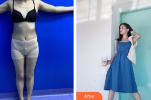 新疆華美整形美容醫(yī)院沈倩云整形價(jià)格表附吸脂減肥案例展示