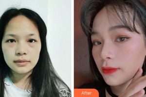 義烏張小紅醫(yī)療美容醫(yī)院李實(shí)忠整形價(jià)格表附皮膚美容案例展示