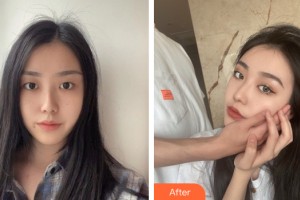 寧夏華美整形美容醫(yī)院樂鳳亮整形價格表附雙眼皮手術案例展示