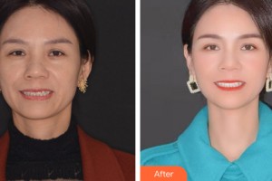 寧夏諾貝爾口腔醫(yī)院趙森整形價格表附牙齒矯正案例展示