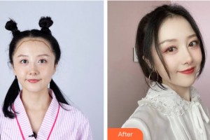 新疆威茲曼整形外科醫(yī)院董君整形價(jià)格表附植發(fā)案例展示