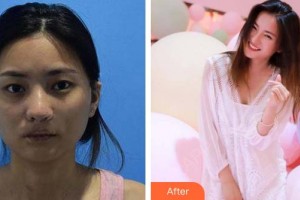 白城春俏美容整形醫(yī)院黃春整形價(jià)格表附埋線提升案例展示