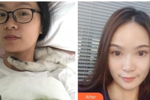 白城春俏美容整形醫(yī)院田宇整形價(jià)格表附熱瑪吉案例展示