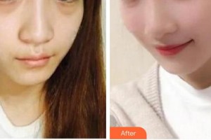 白城春俏美容整形醫(yī)院李海英住院醫(yī)師整形價(jià)格表附埋線提升案例展示