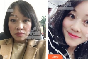 白城春俏美容整形醫(yī)院黃潔整形價(jià)格表附埋線提升案例展示