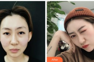 陜西省人民醫(yī)院燒傷整形醫(yī)學(xué)美容科康淑檀整形價(jià)格表附埋線提升案例展示