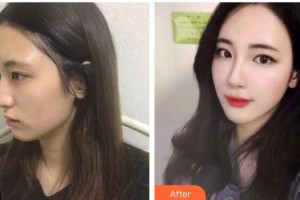 陜西華西醫(yī)院西美整形美容中心張菊芳整形價(jià)格表附假體隆鼻案例展示