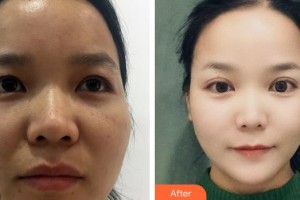 陜西省人民醫(yī)院燒傷整形醫(yī)學(xué)美容科張振信整形價(jià)格表附切開(kāi)雙眼皮案例展示